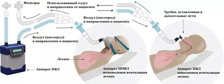 Инвазивная неинвазивная вентиляция
