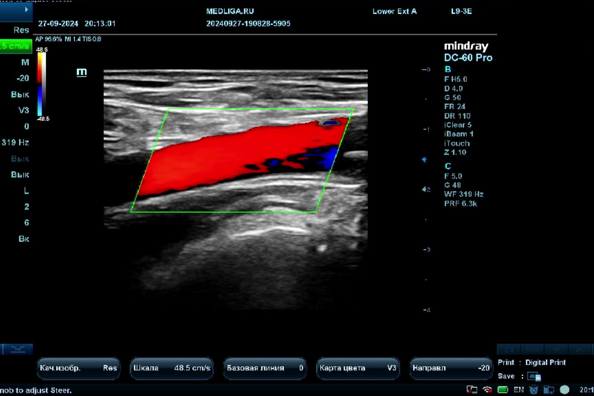 УЗИ артерий нижних конечностей на Mindray DC-60 Pro