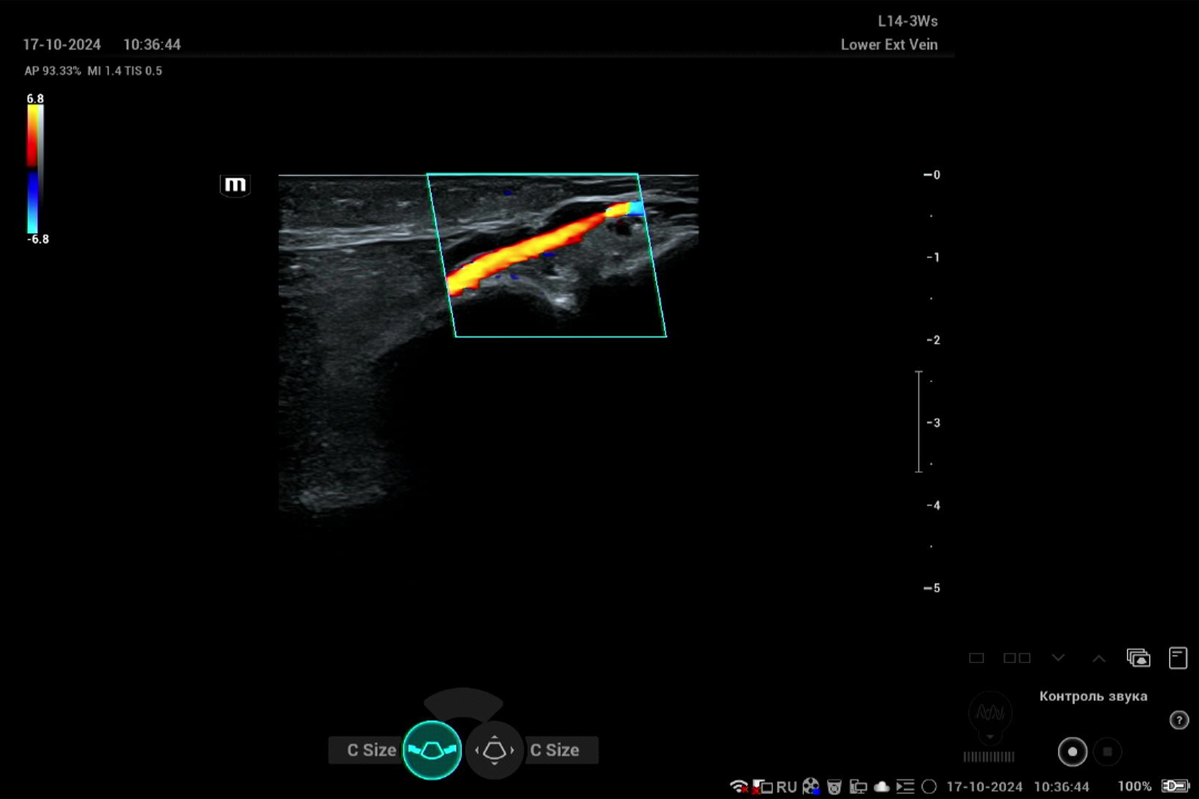 УЗИ вен нижних конечностей после лечения тромбоза на Mindray Resona i9