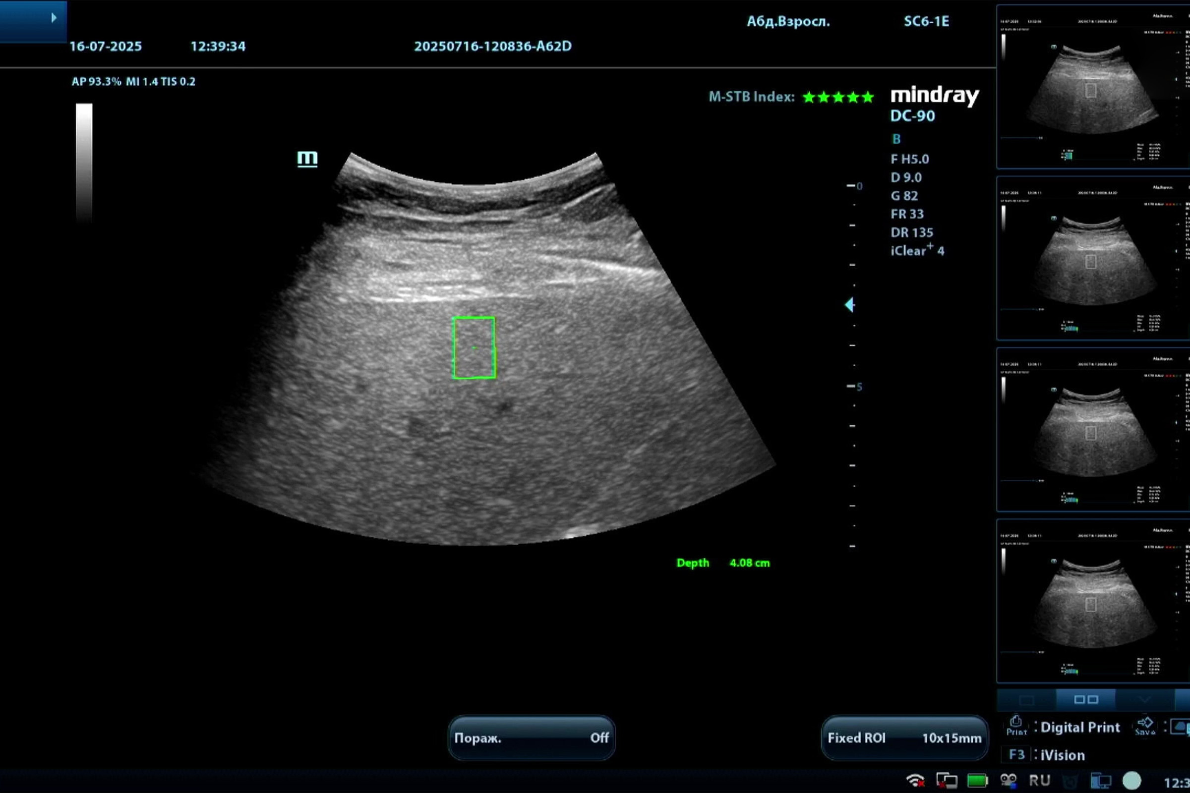 Эластография печени на Mindray DC-90: диагностика фиброза