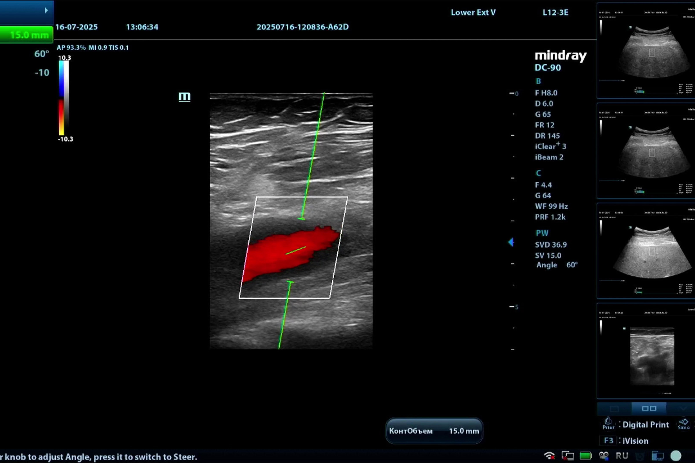 Мастер-класс по УЗИ глубоких вен нижних конечностей на Mindray DC-90