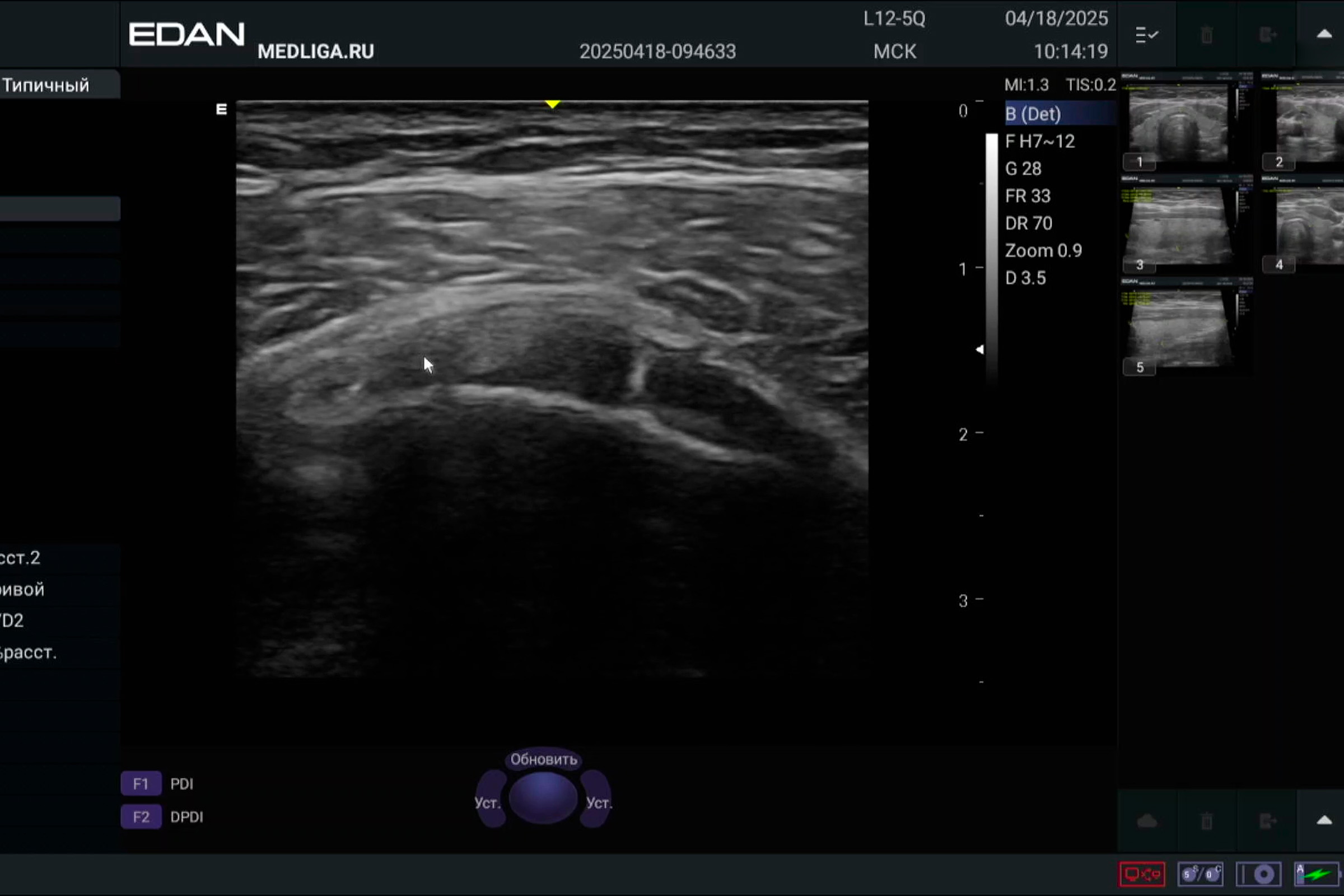 Оценка функционала Edan Acclarix AX3 на примере УЗИ плеча